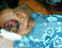 Nenek Giyem, Penderita Tumor Dimata Butuh Uluran Tangan Dermawan