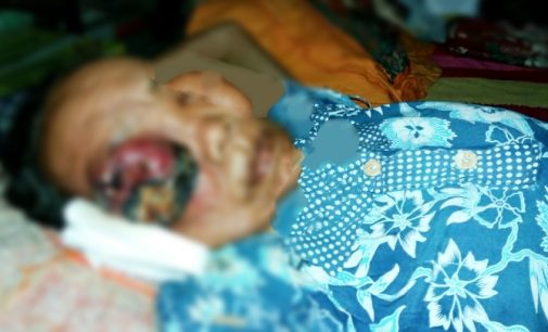 Nenek Giyem, Penderita Tumor Dimata Butuh Uluran Tangan Dermawan